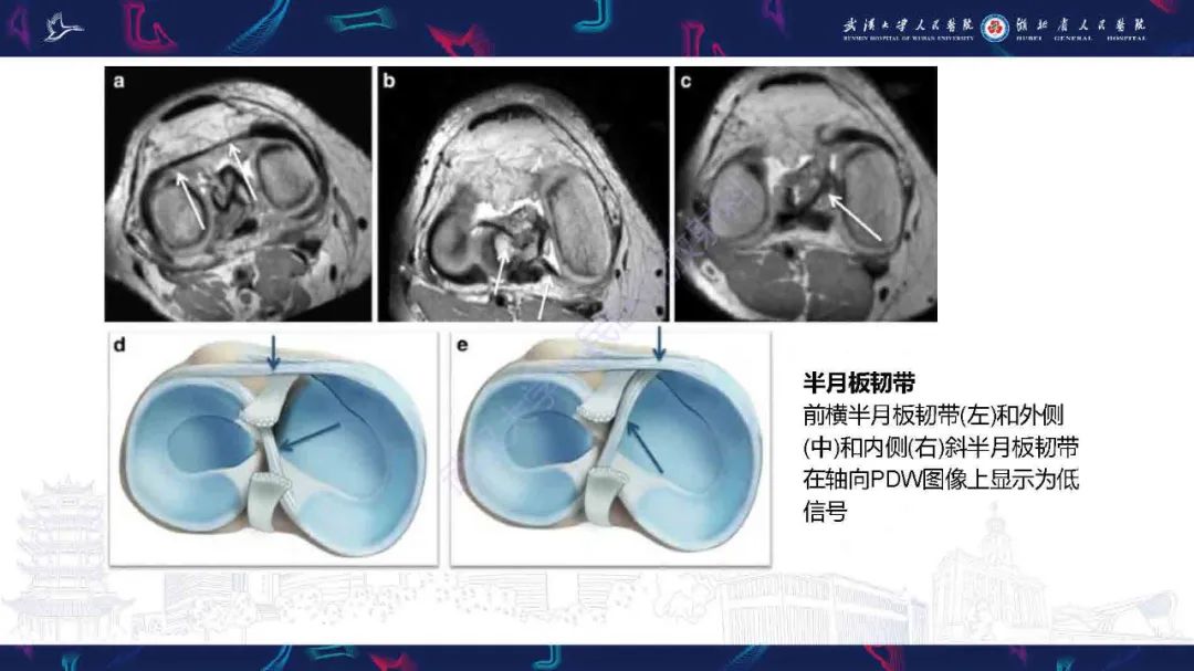 影像PPT - 【PPT】膝关节T2WI低信号病变影像诊断-11