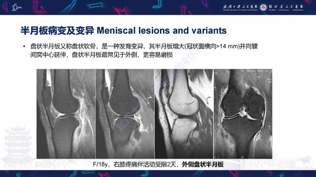 影像PPT - 【PPT】膝关节T2WI低信号病变影像诊断-12