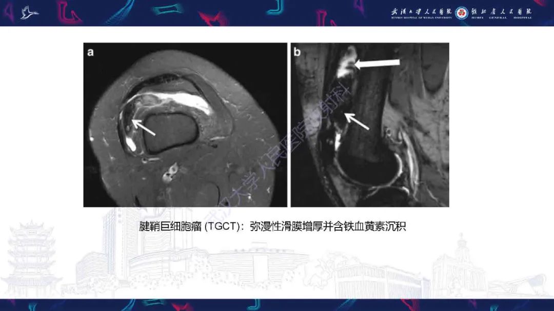 影像PPT - 【PPT】膝关节T2WI低信号病变影像诊断-14