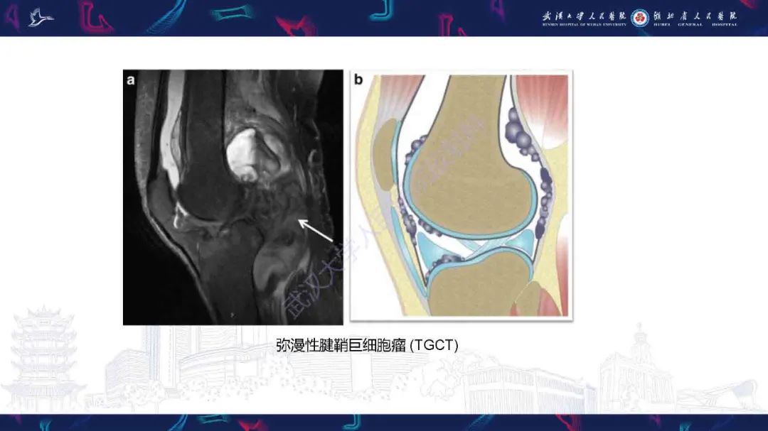 影像PPT - 【PPT】膝关节T2WI低信号病变影像诊断-15