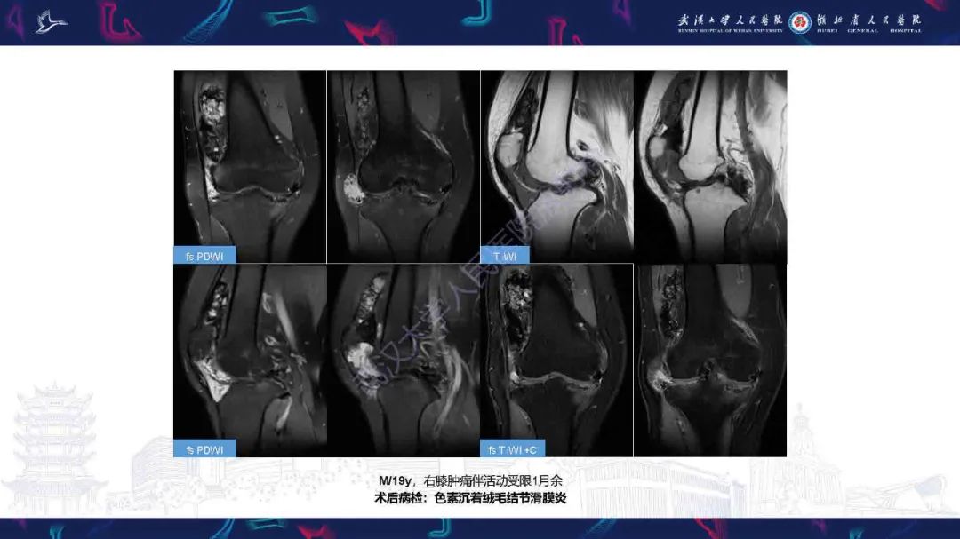 影像PPT - 【PPT】膝关节T2WI低信号病变影像诊断-16