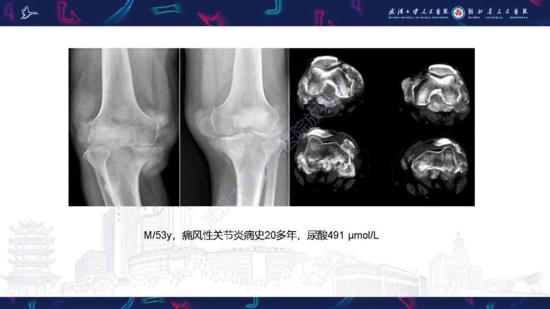 影像PPT - 【PPT】膝关节T2WI低信号病变影像诊断-19