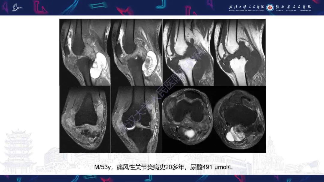 影像PPT - 【PPT】膝关节T2WI低信号病变影像诊断-20