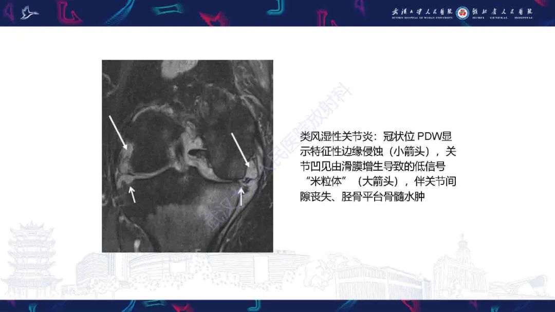 影像PPT - 【PPT】膝关节T2WI低信号病变影像诊断-22