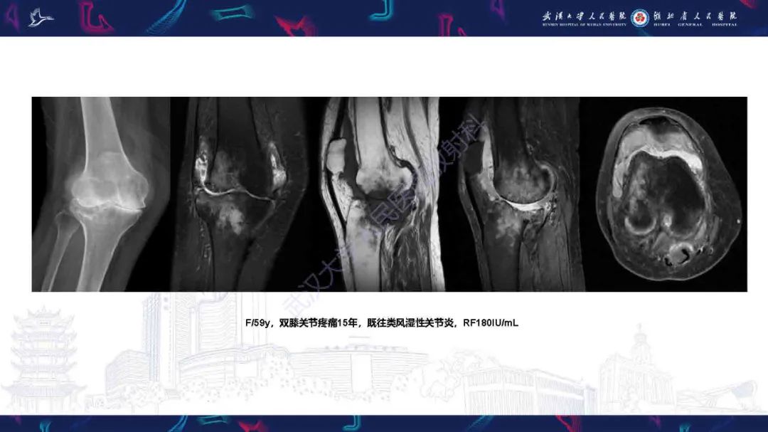 影像PPT - 【PPT】膝关节T2WI低信号病变影像诊断-23