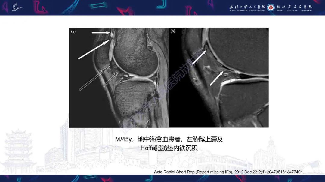 影像PPT - 【PPT】膝关节T2WI低信号病变影像诊断-25