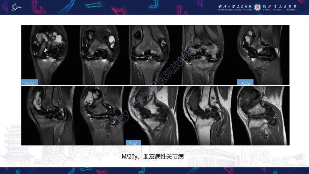 影像PPT - 【PPT】膝关节T2WI低信号病变影像诊断-27