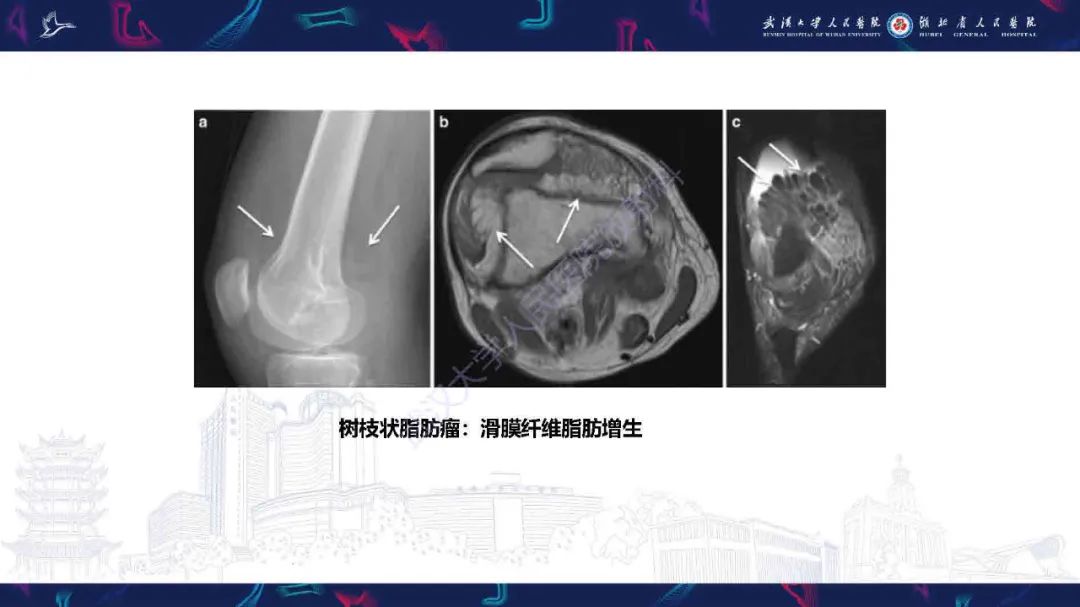 影像PPT - 【PPT】膝关节T2WI低信号病变影像诊断-29