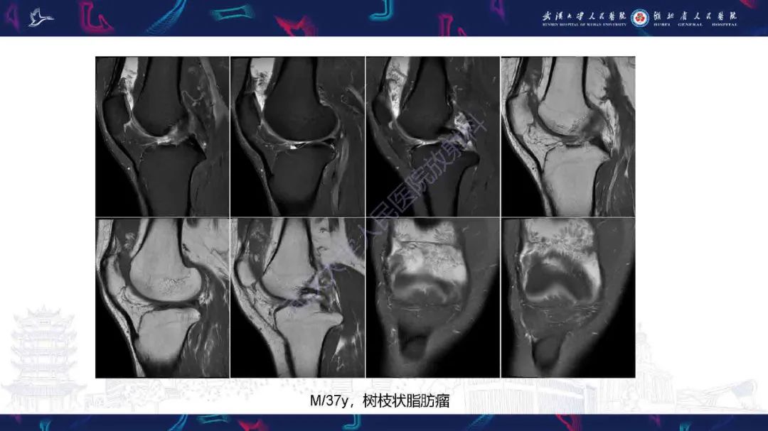 影像PPT - 【PPT】膝关节T2WI低信号病变影像诊断-30
