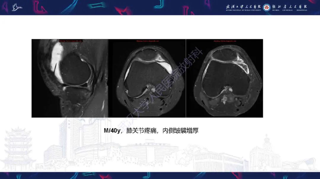 影像PPT - 【PPT】膝关节T2WI低信号病变影像诊断-32