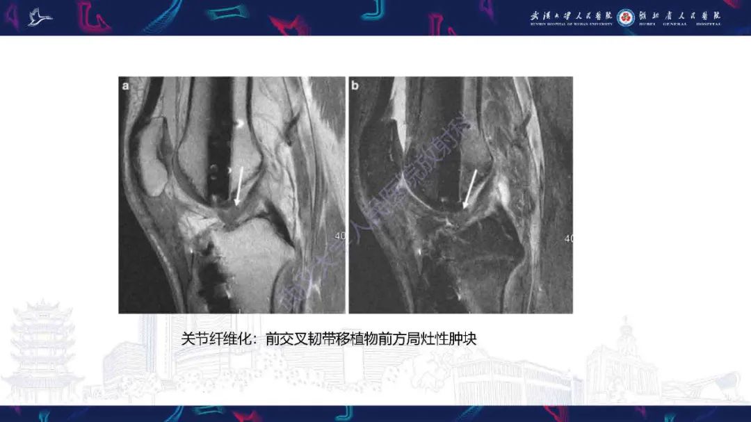 影像PPT - 【PPT】膝关节T2WI低信号病变影像诊断-34