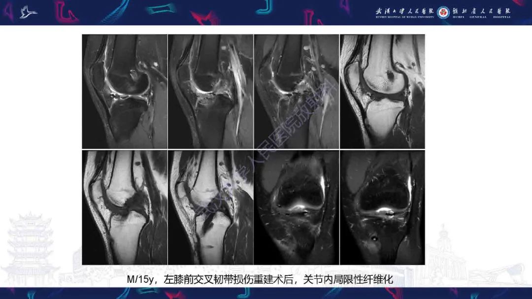 影像PPT - 【PPT】膝关节T2WI低信号病变影像诊断-35
