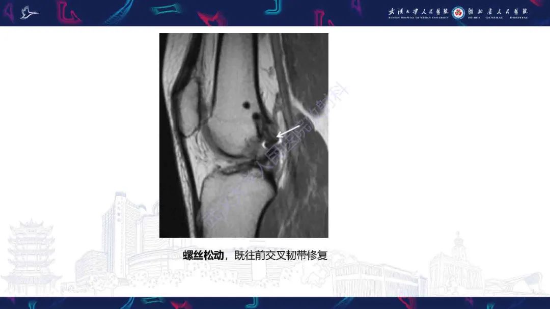 影像PPT - 【PPT】膝关节T2WI低信号病变影像诊断-37