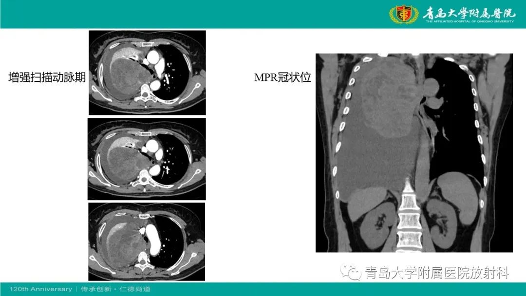 影像PPT - 【PPT】胸膜孤立性纤维性肿瘤-4