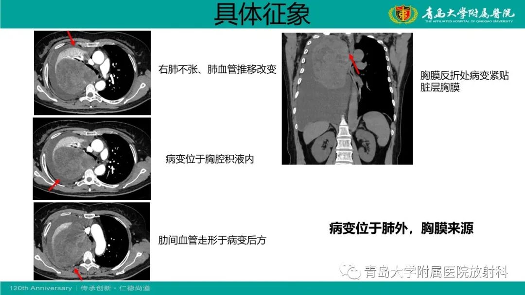 影像PPT - 【PPT】胸膜孤立性纤维性肿瘤-7