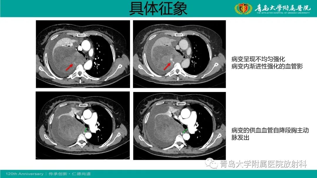 影像PPT - 【PPT】胸膜孤立性纤维性肿瘤-8