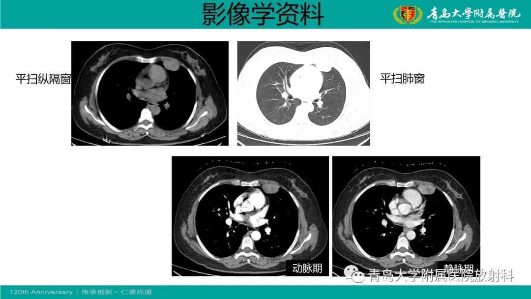 影像PPT - 【PPT】胸膜孤立性纤维性肿瘤-11