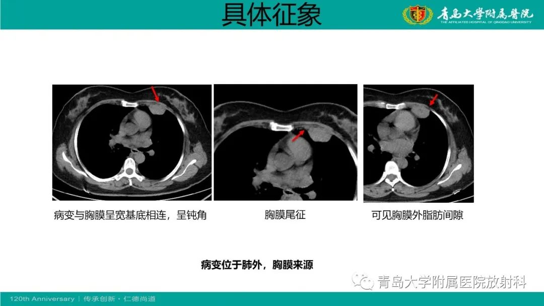 影像PPT - 【PPT】胸膜孤立性纤维性肿瘤-12