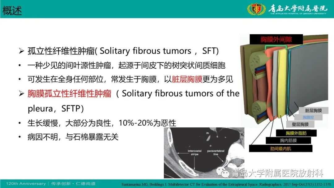 影像PPT - 【PPT】胸膜孤立性纤维性肿瘤-15