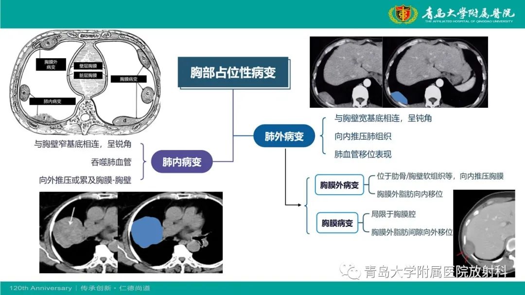 影像PPT - 【PPT】胸膜孤立性纤维性肿瘤-16