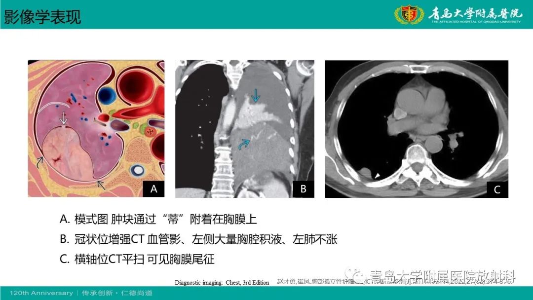 影像PPT - 【PPT】胸膜孤立性纤维性肿瘤-22