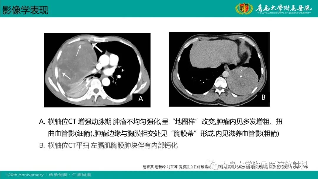影像PPT - 【PPT】胸膜孤立性纤维性肿瘤-23