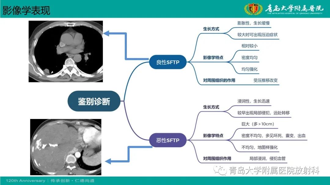 影像PPT - 【PPT】胸膜孤立性纤维性肿瘤-24