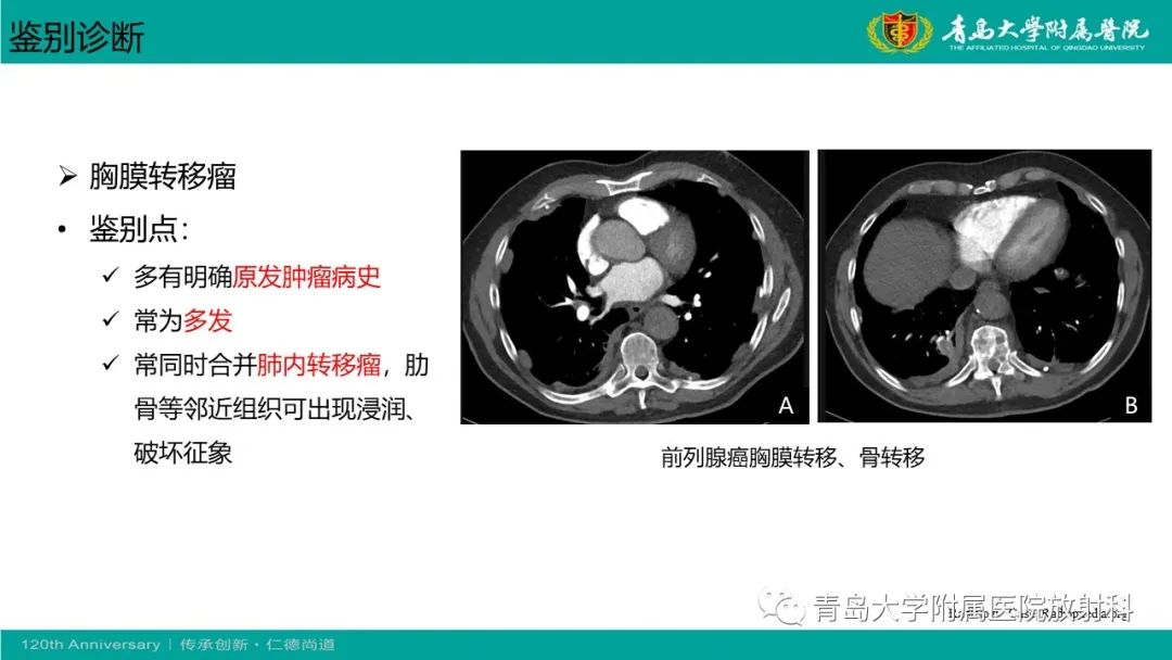 影像PPT - 【PPT】胸膜孤立性纤维性肿瘤-27