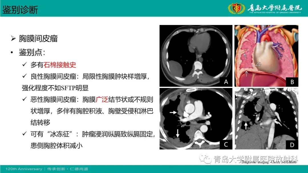 影像PPT - 【PPT】胸膜孤立性纤维性肿瘤-26