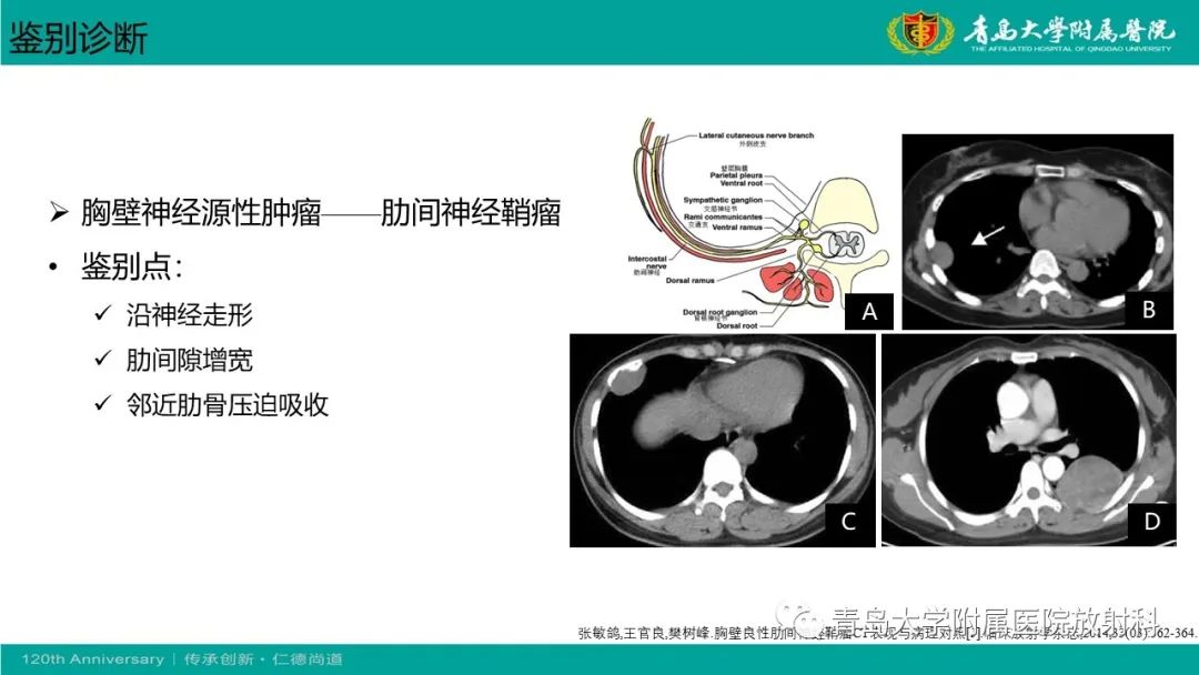 影像PPT - 【PPT】胸膜孤立性纤维性肿瘤-28