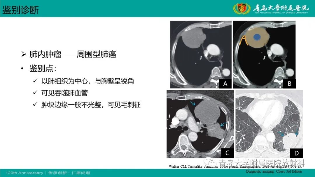影像PPT - 【PPT】胸膜孤立性纤维性肿瘤-29
