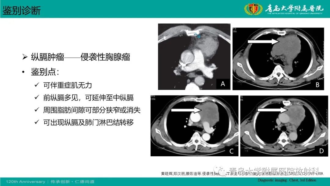 影像PPT - 【PPT】胸膜孤立性纤维性肿瘤-30