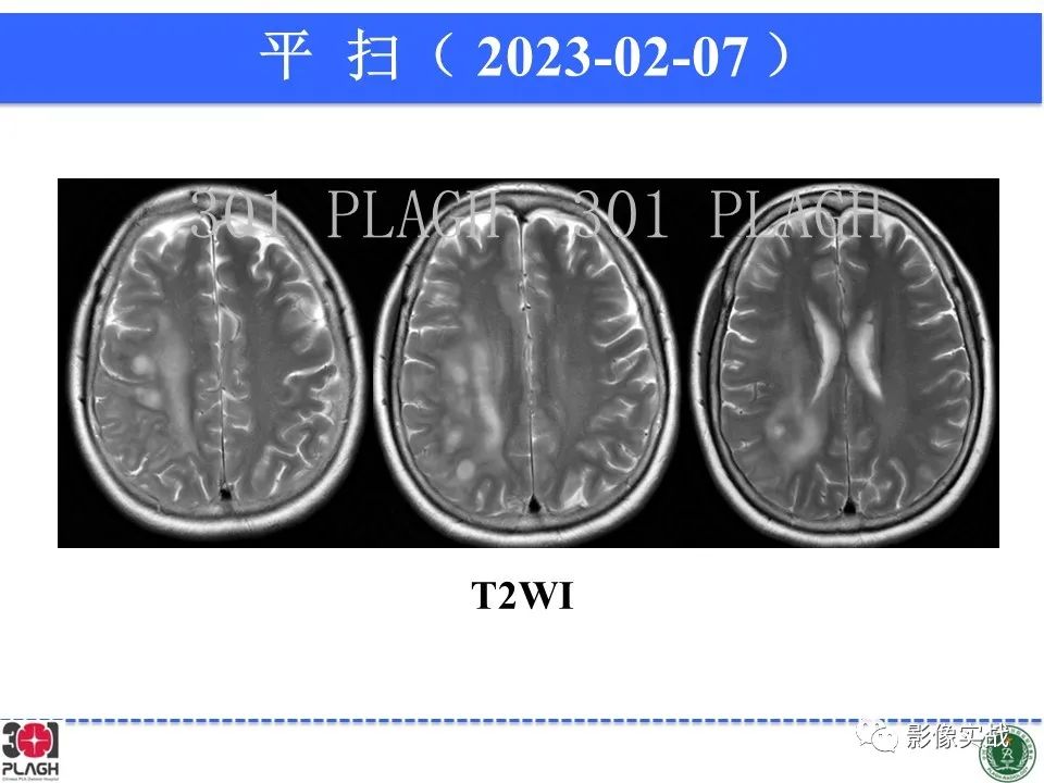 影像PPT - 【病例】胶质母细胞瘤1例MR影像-5