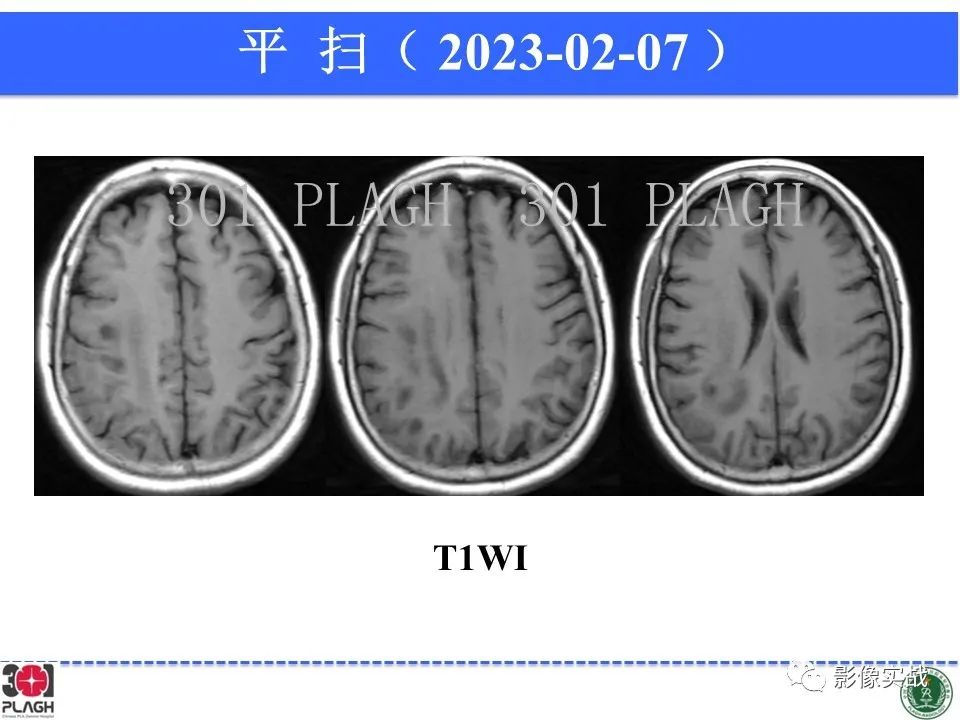 影像PPT - 【病例】胶质母细胞瘤1例MR影像-6