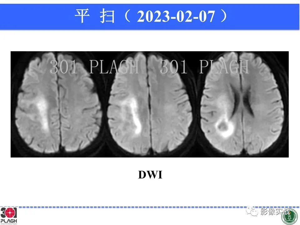 影像PPT - 【病例】胶质母细胞瘤1例MR影像-7