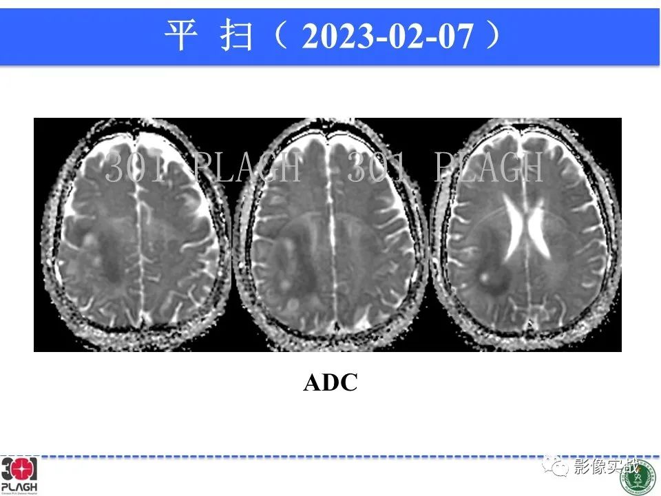 影像PPT - 【病例】胶质母细胞瘤1例MR影像-8