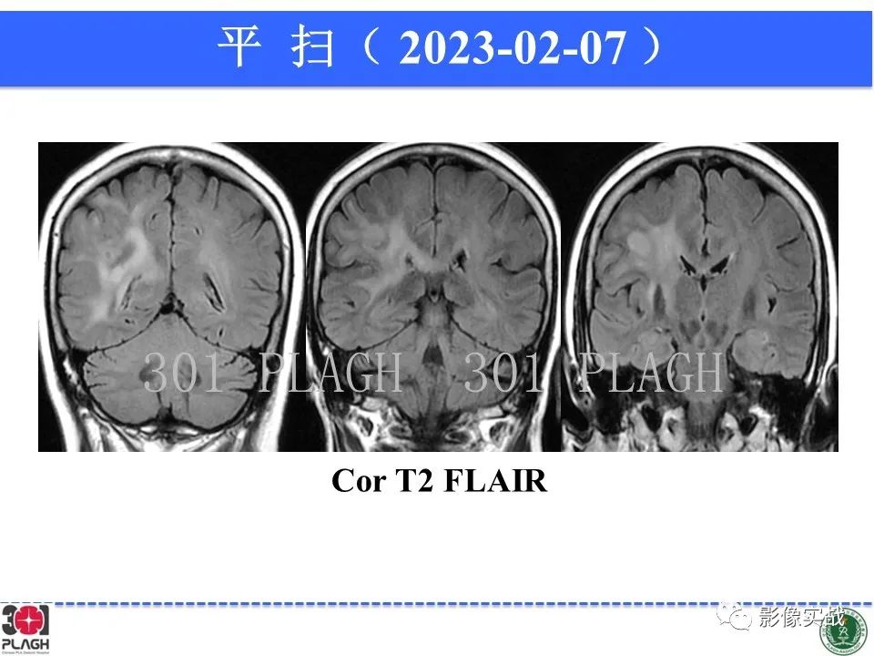 影像PPT - 【病例】胶质母细胞瘤1例MR影像-9