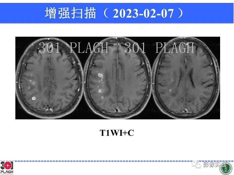 影像PPT - 【病例】胶质母细胞瘤1例MR影像-10