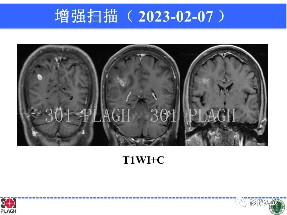 影像PPT - 【病例】胶质母细胞瘤1例MR影像-11
