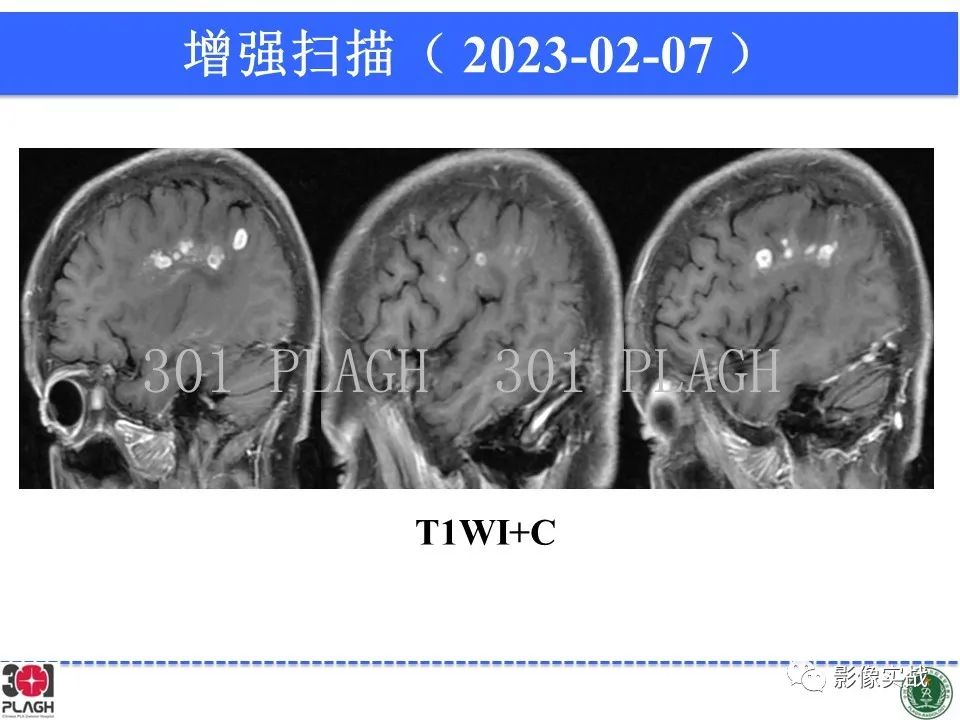 影像PPT - 【病例】胶质母细胞瘤1例MR影像-12