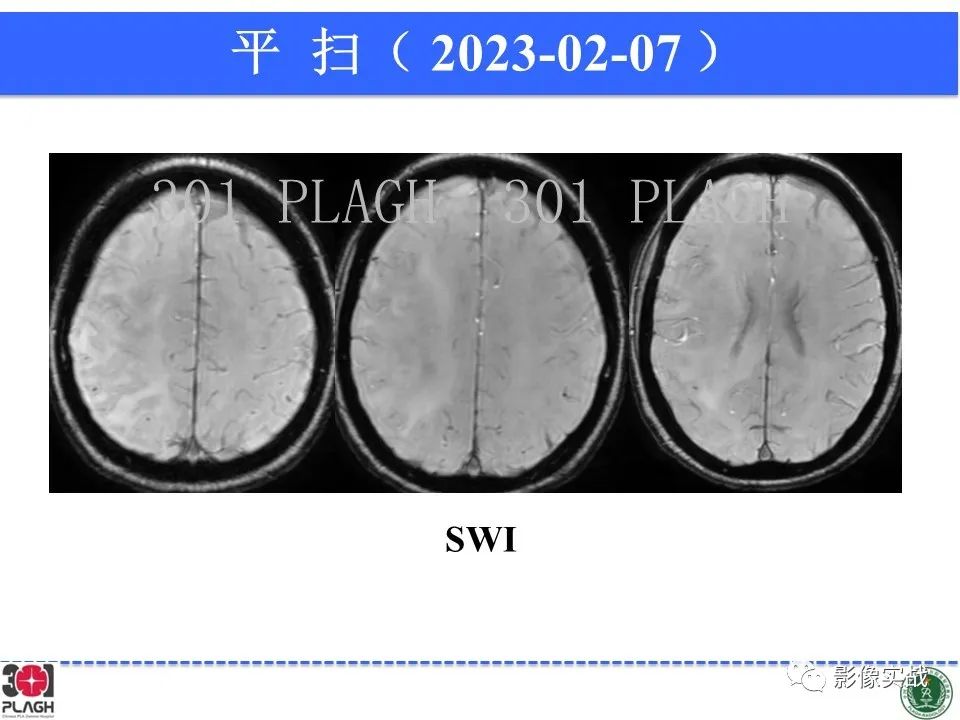 影像PPT - 【病例】胶质母细胞瘤1例MR影像-13