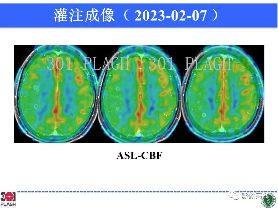 影像PPT - 【病例】胶质母细胞瘤1例MR影像-14