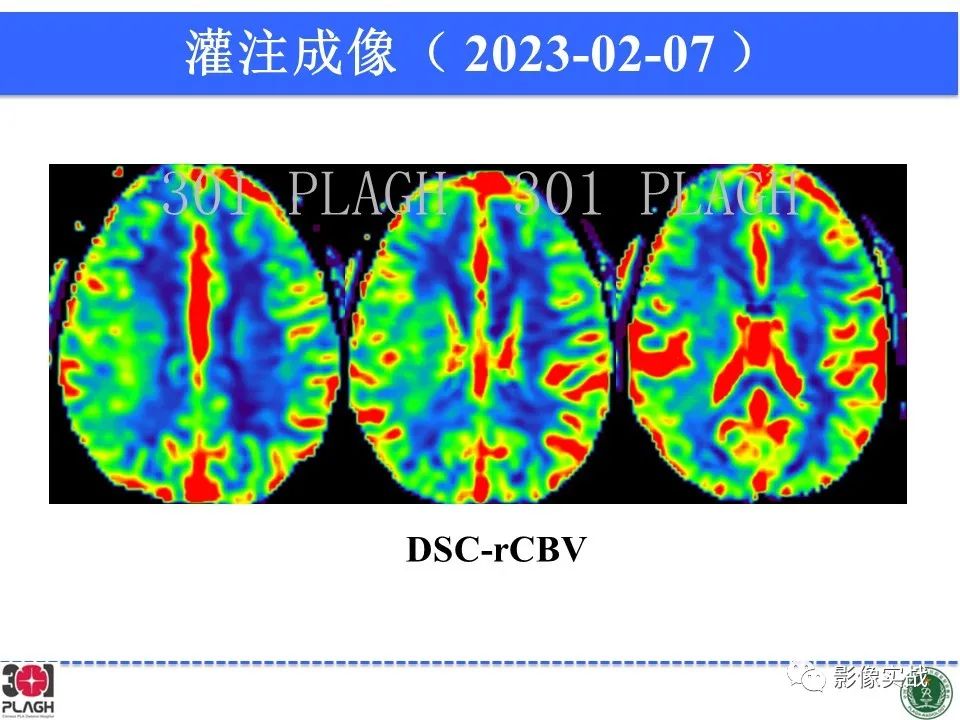 影像PPT - 【病例】胶质母细胞瘤1例MR影像-15