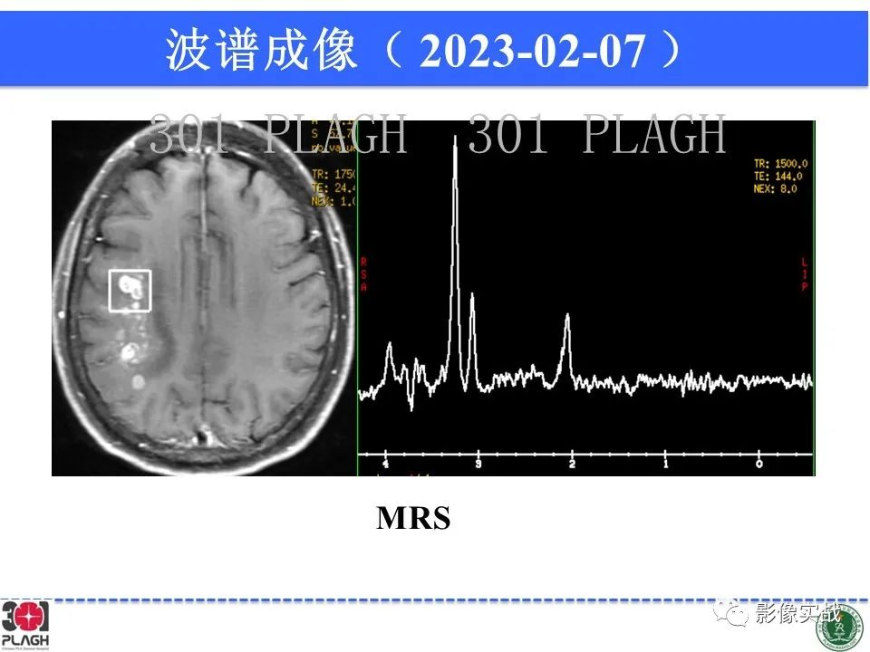 影像PPT - 【病例】胶质母细胞瘤1例MR影像-16