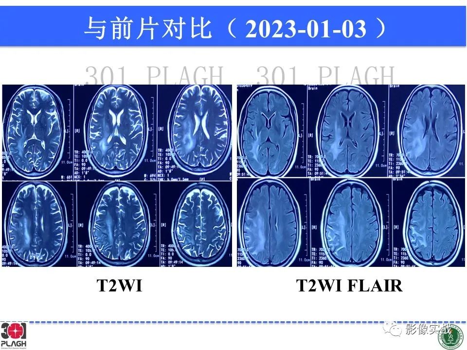 影像PPT - 【病例】胶质母细胞瘤1例MR影像-17