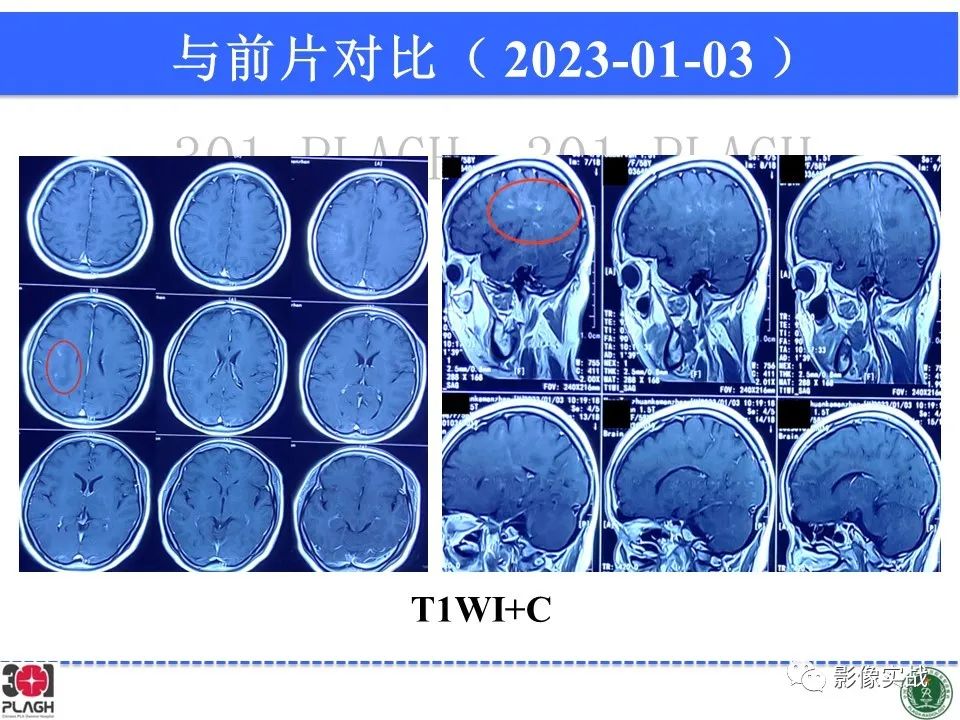 影像PPT - 【病例】胶质母细胞瘤1例MR影像-18