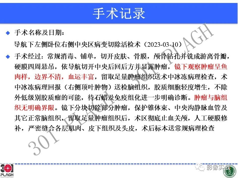影像PPT - 【病例】胶质母细胞瘤1例MR影像-25