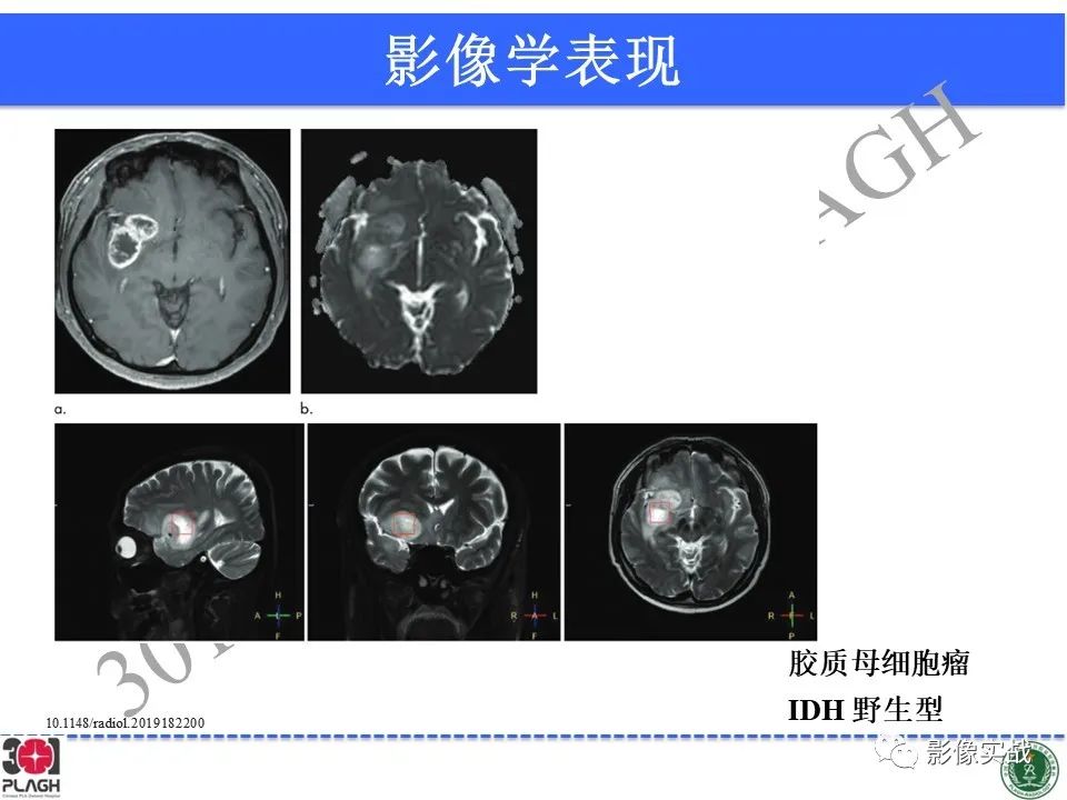 影像PPT - 【病例】胶质母细胞瘤1例MR影像-30