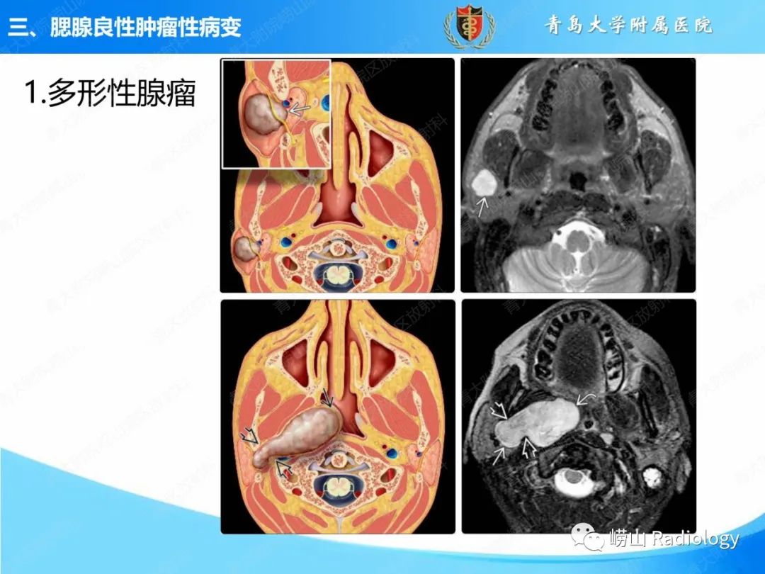 影像PPT - 【PPT】腮腺肿瘤性病变的影像学诊断思路及功能MRI价值评估-13