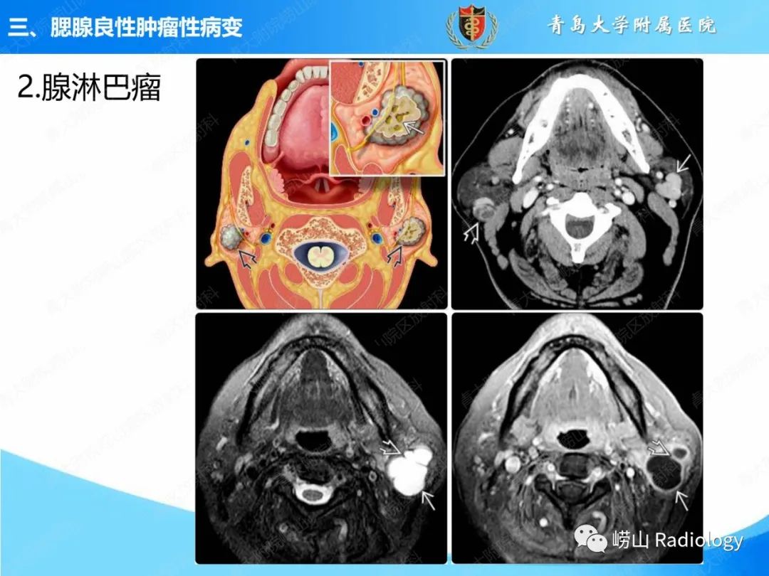 影像PPT - 【PPT】腮腺肿瘤性病变的影像学诊断思路及功能MRI价值评估-17
